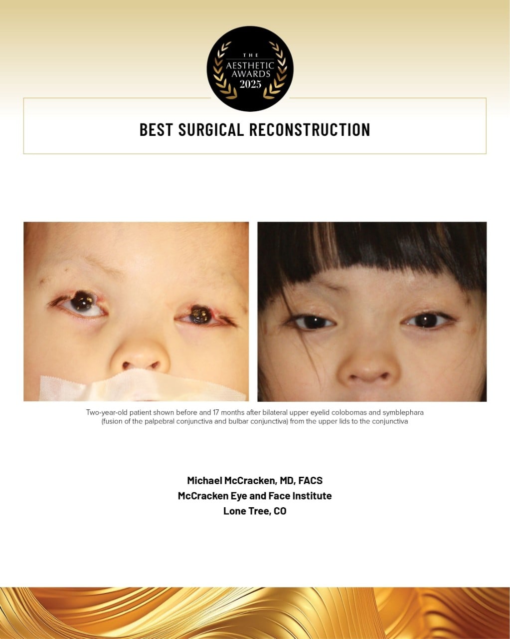 surgical reconstruction