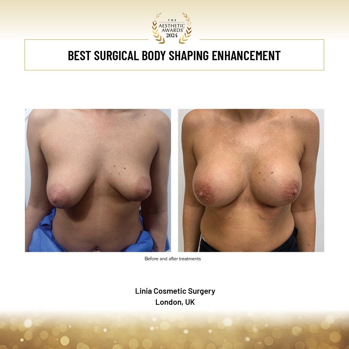 Best Surg Body Shaping