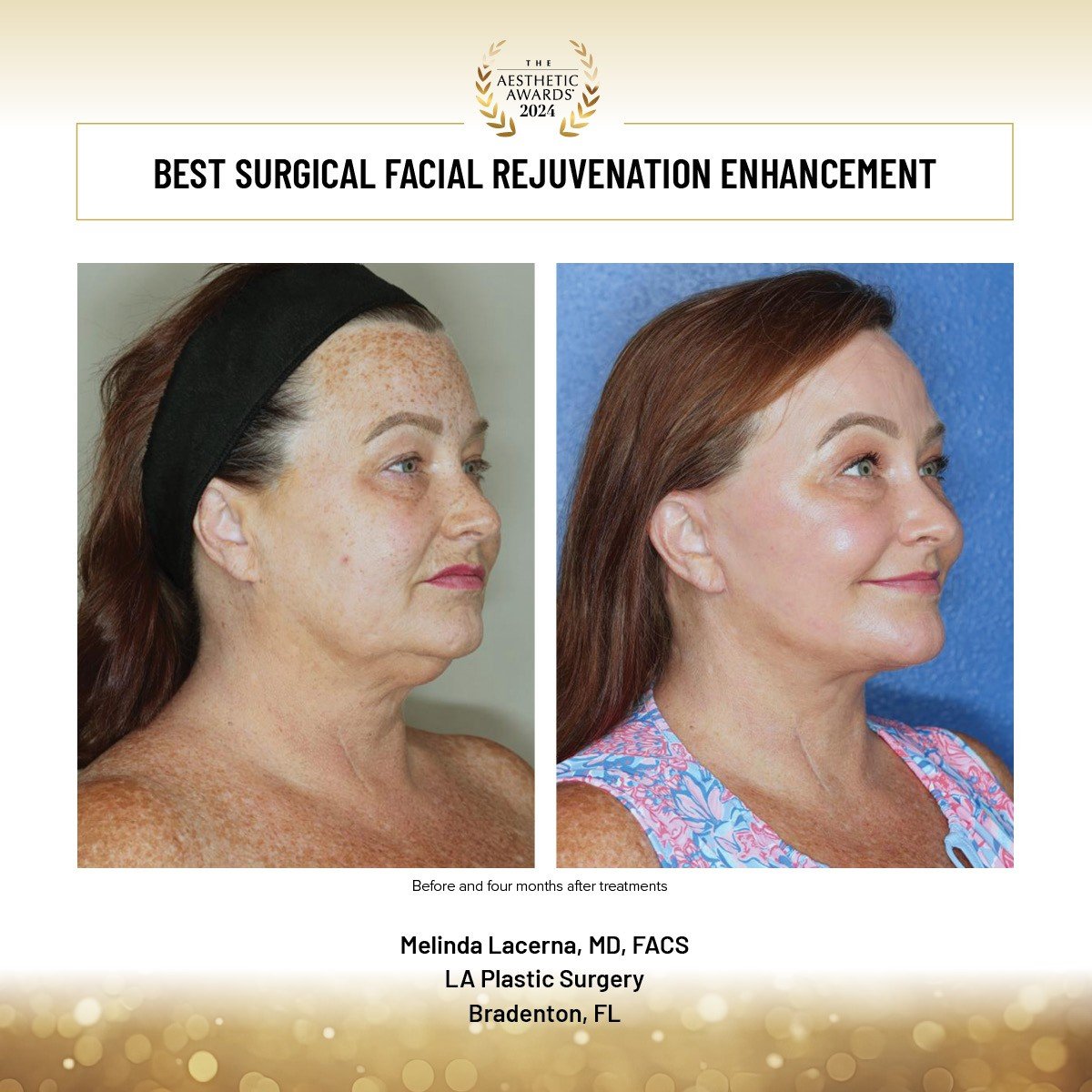 Best Surgical Face